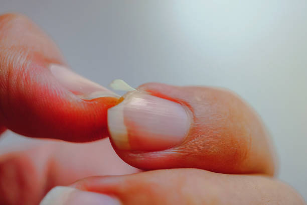 PDF] The disappearing nail bed: a possible outcome of onycholysis. |  Semantic Scholar